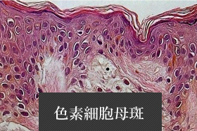 色素細胞母斑